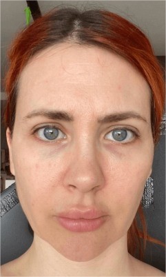 Under Eye Fillers before