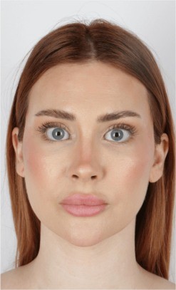 Under Eye Fillers after