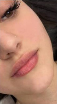 Lip Fillers before